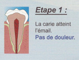 Carie étape 1 - 